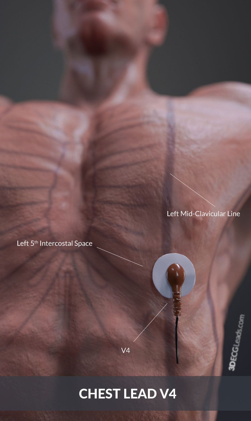 5th intercostal space midclavicular line